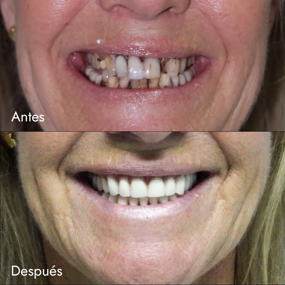 Prótesis removible sobre implantes