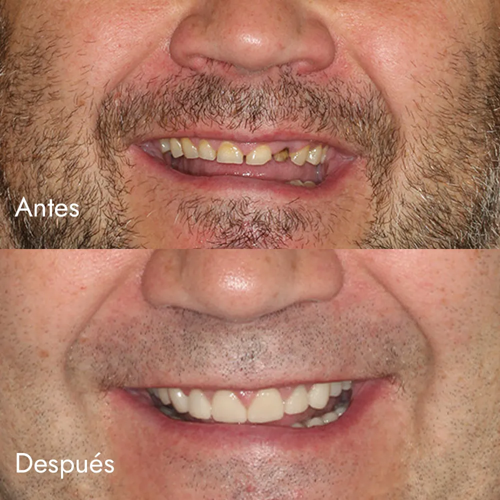 Rehabilitación oral