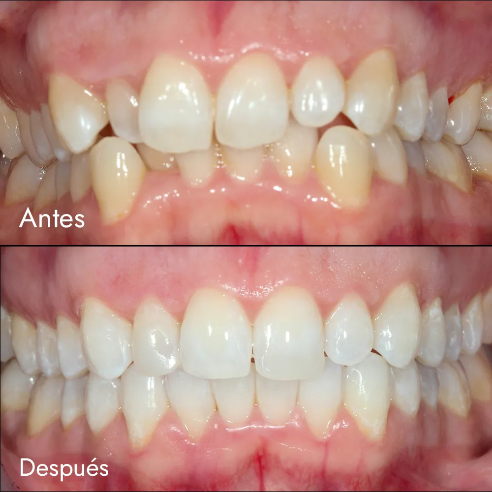 Ortodoncia invisible