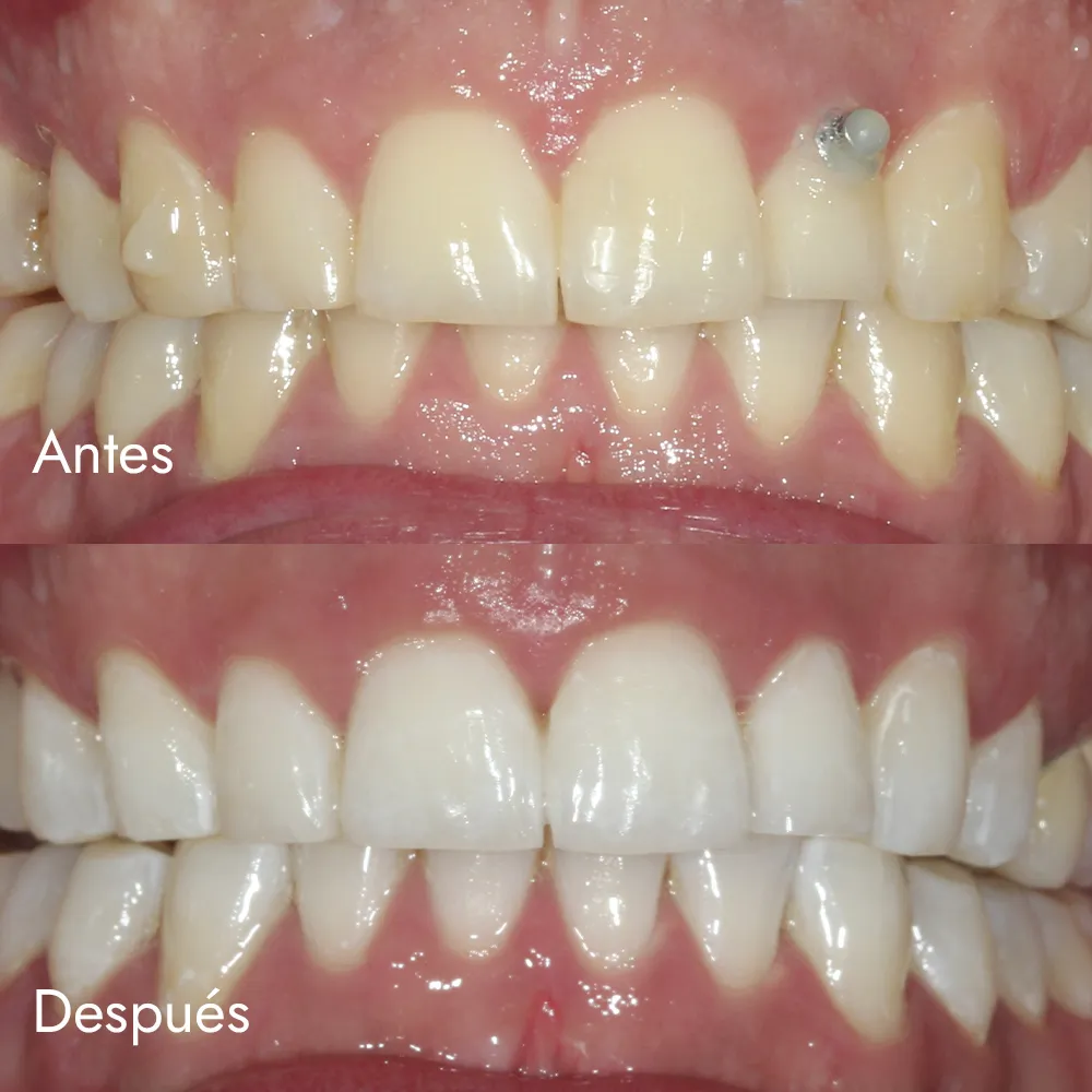 Blanqueamiento dental