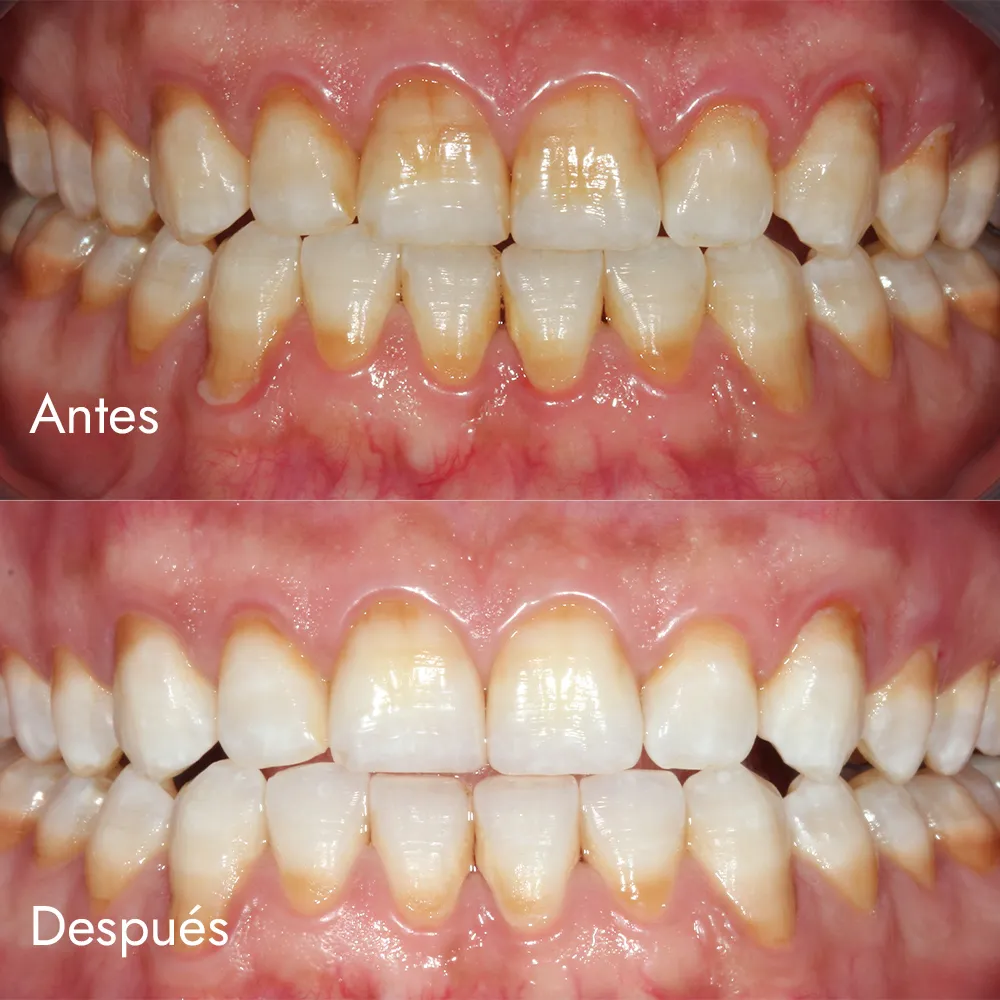 Blanqueamiento dental