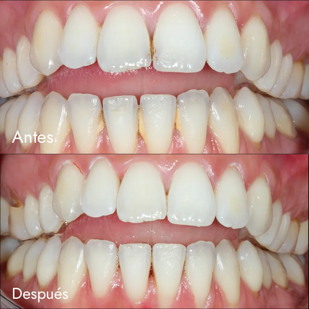 Limpieza + aeropulido