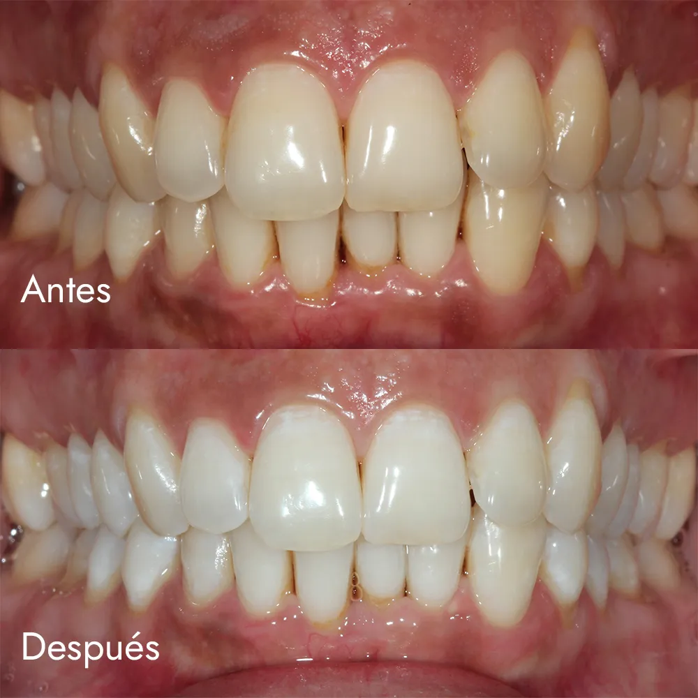 Blanqueamiento dental