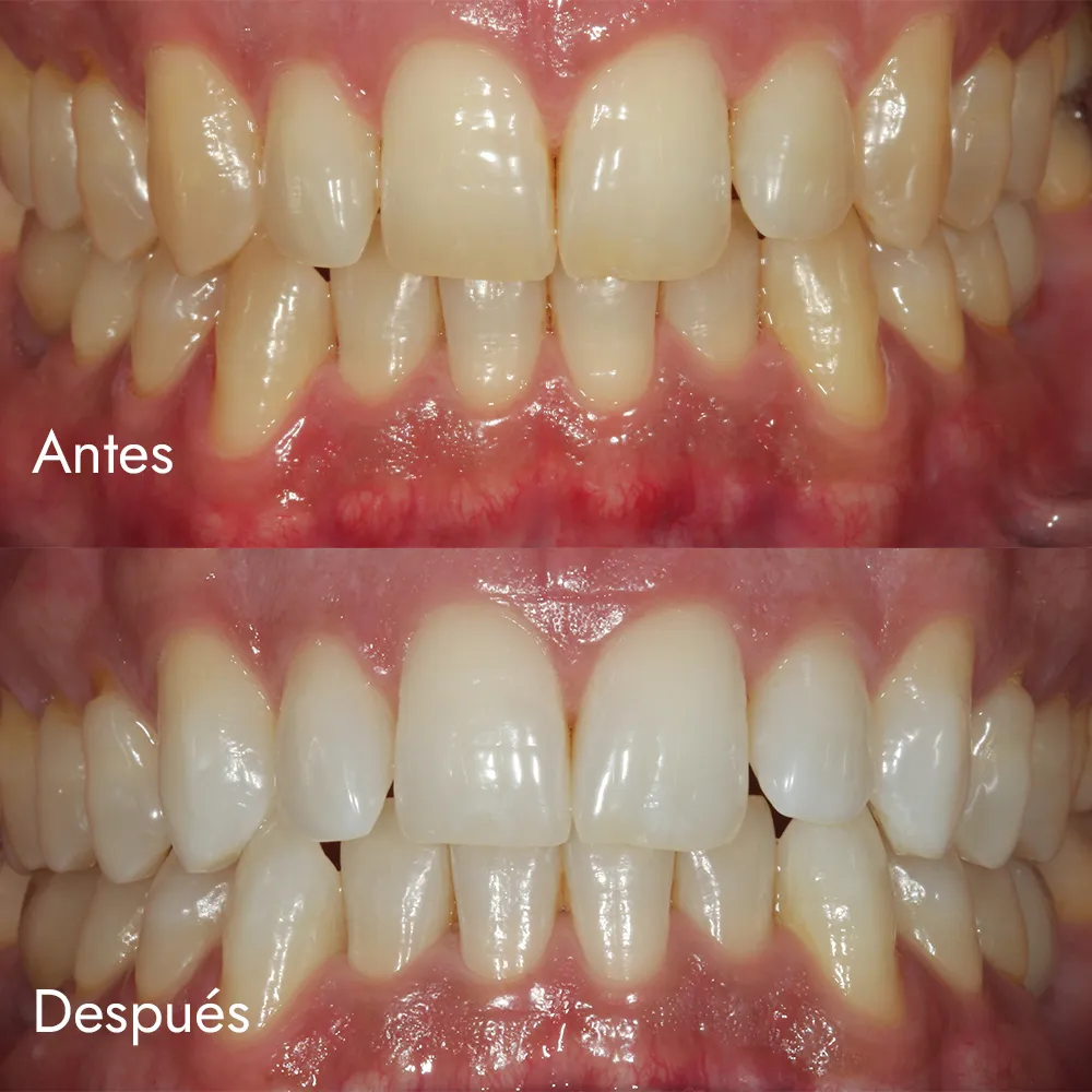 Blanqueamiento dental