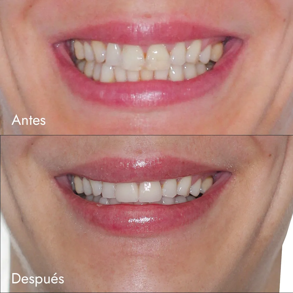 Blanqueamiento + Carillas