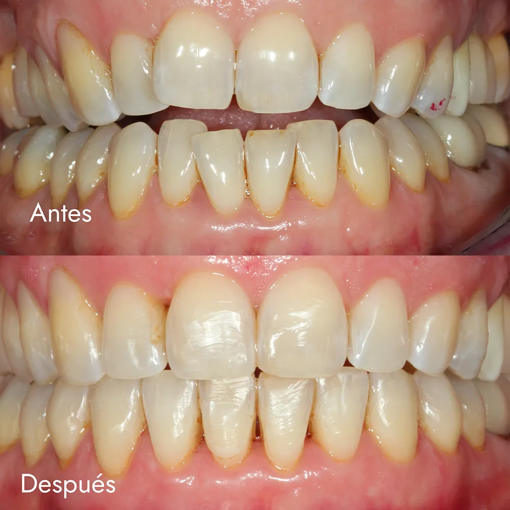 Ortodoncia invisible