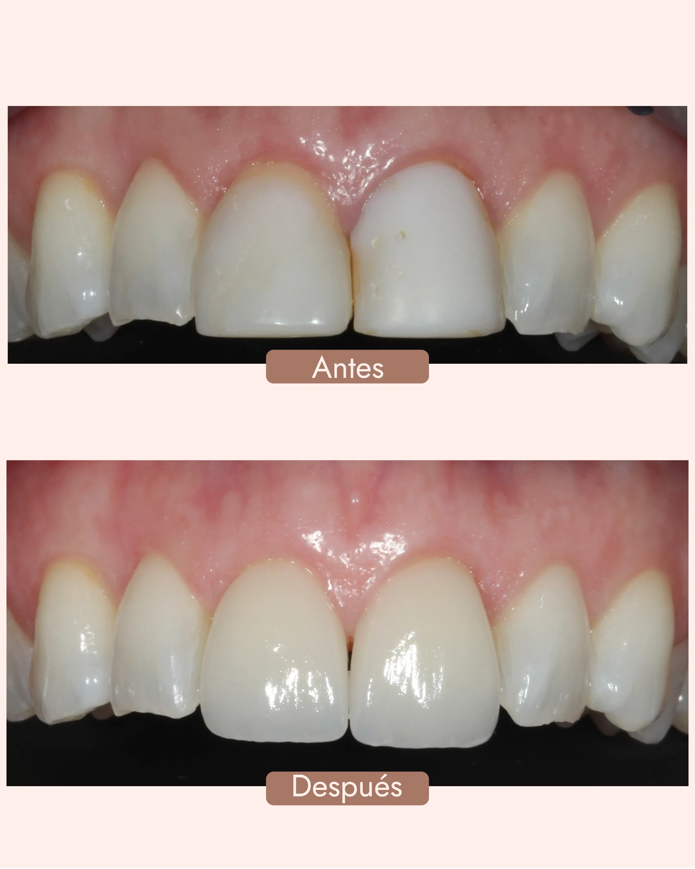 Antes y Después: Carillas Dentales