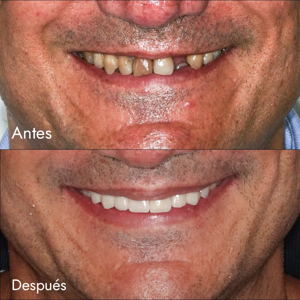 Rehabilitación oral