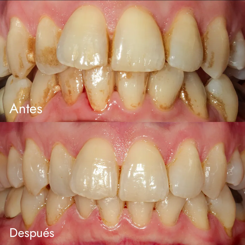 Limpieza + aeropulido