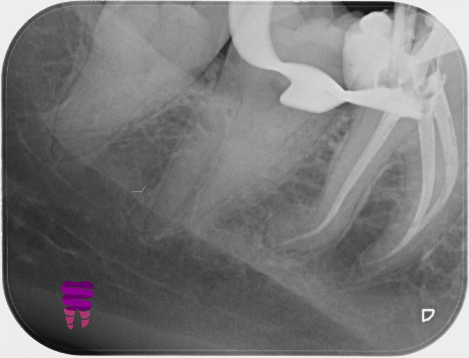 Endodoncia