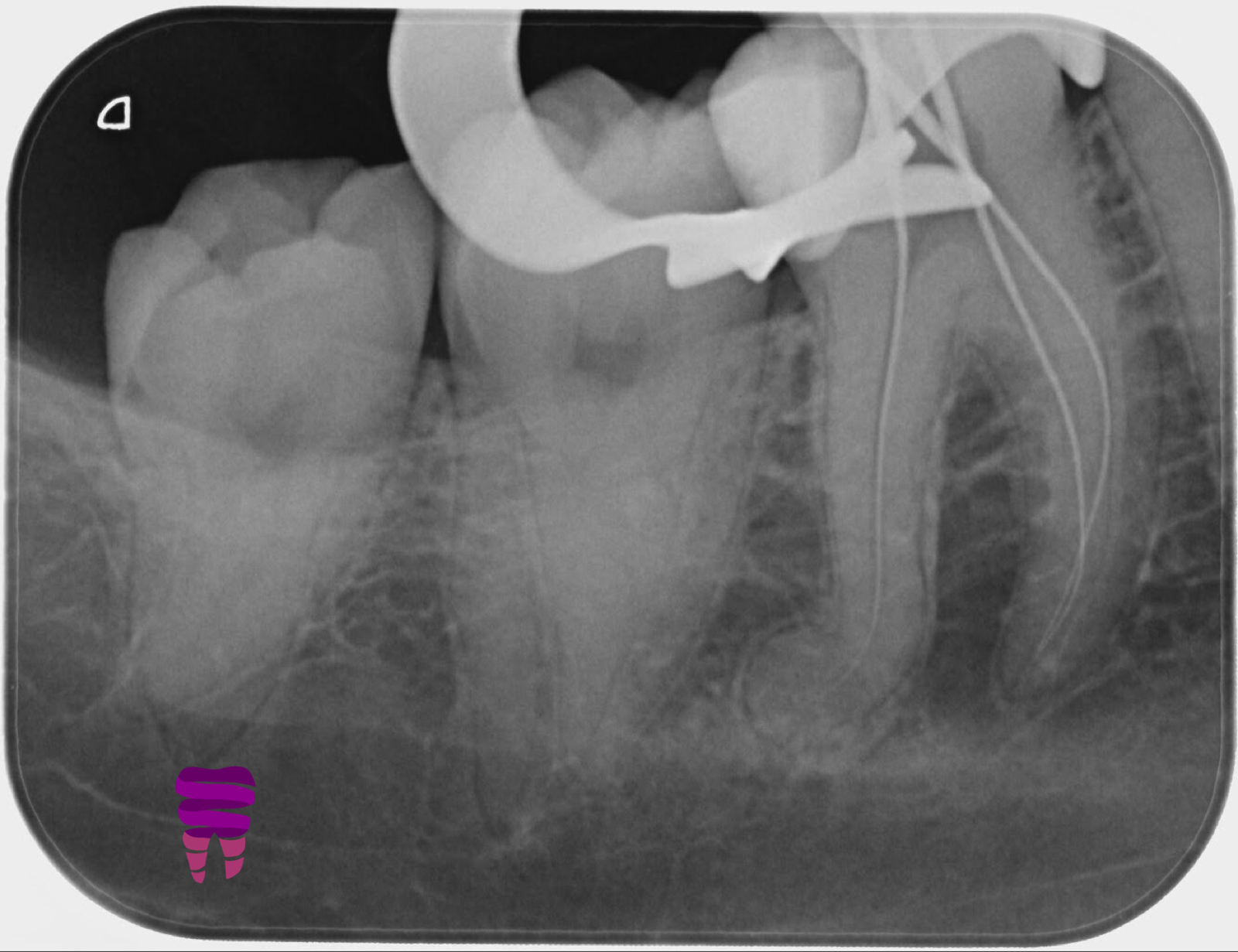 Endodoncia