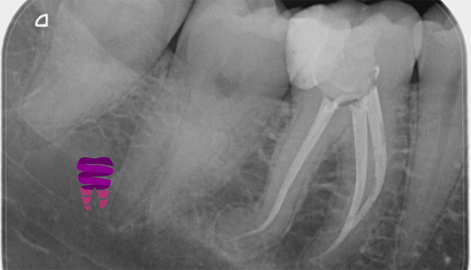 Endodoncia