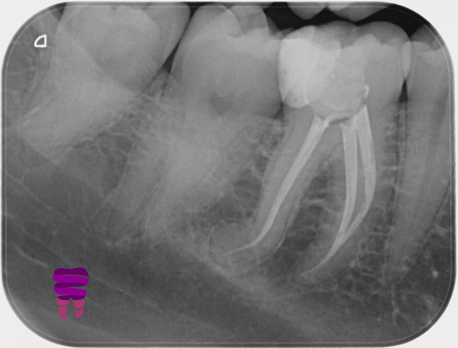 Endodoncia