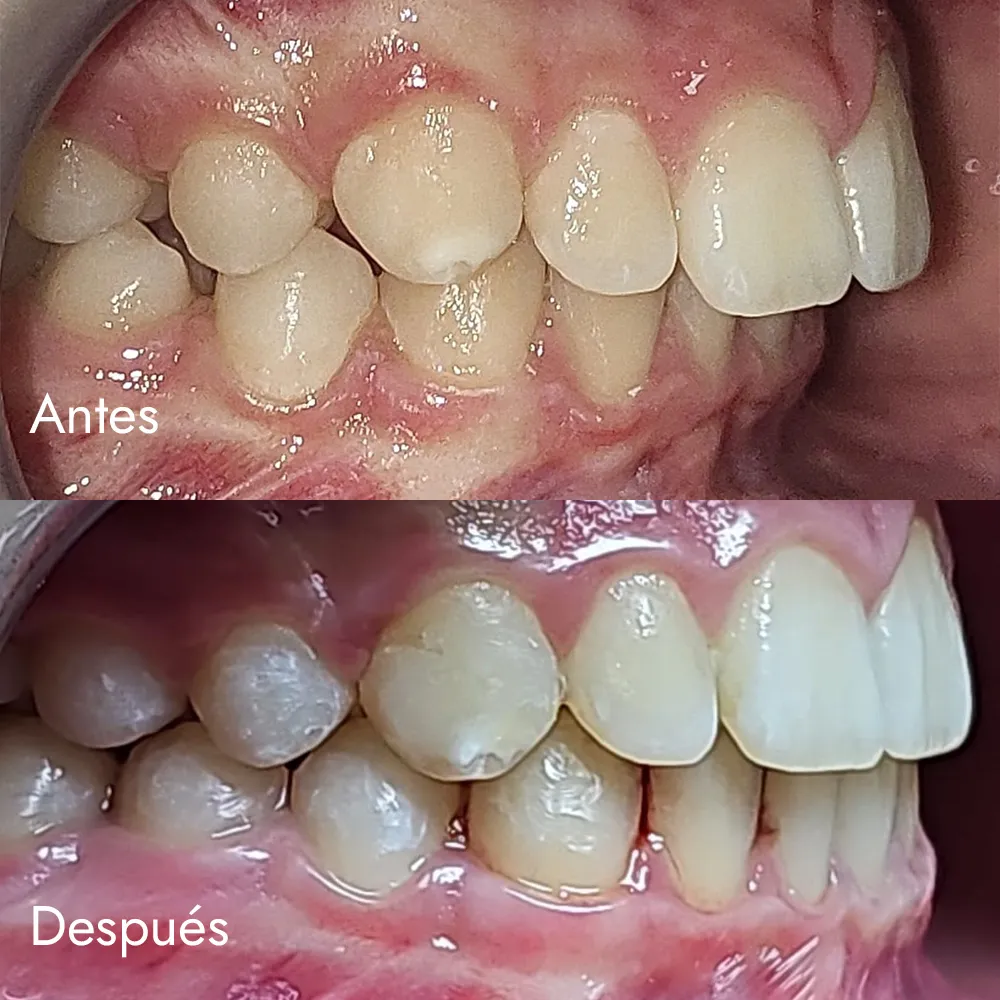 Ortodoncia invisible