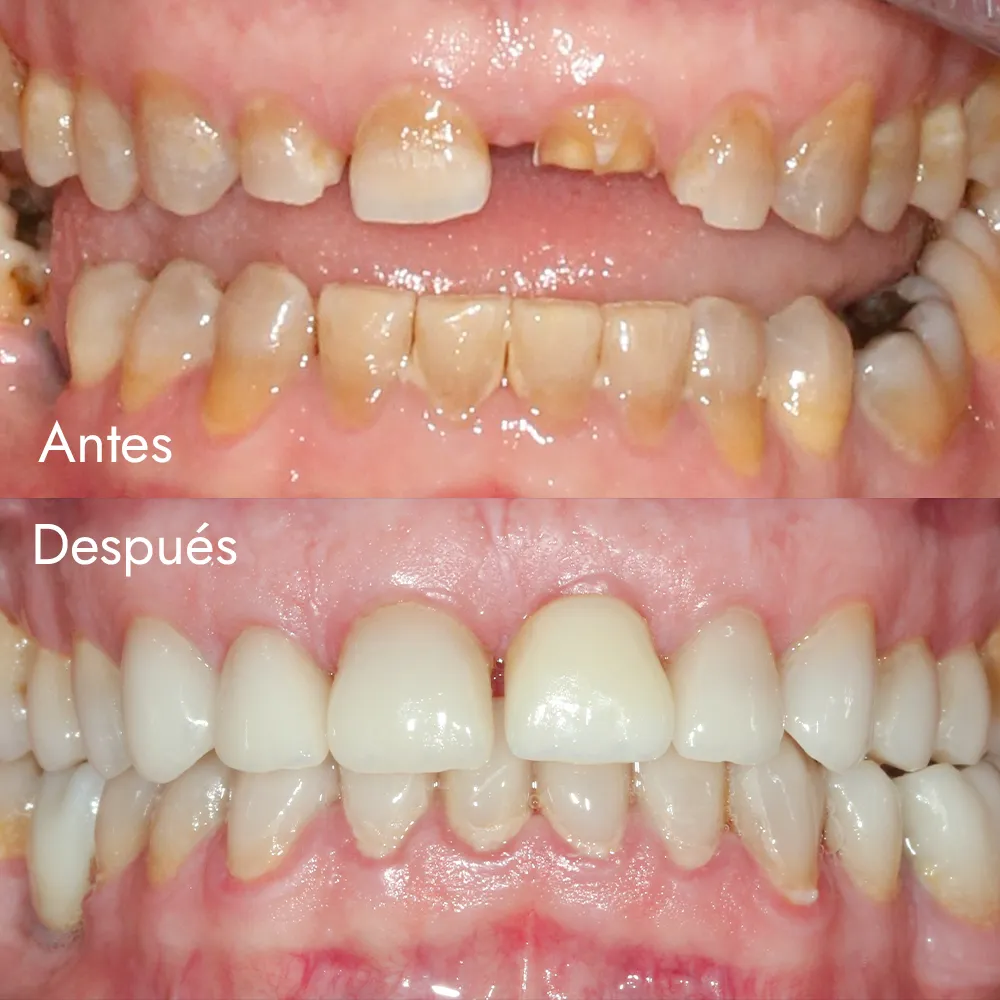 Rehabilitación oral