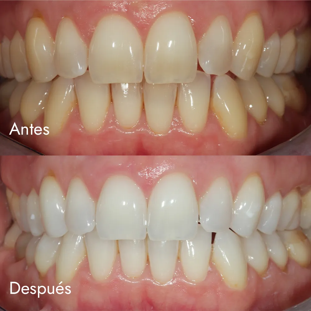 Blanqueamiento dental