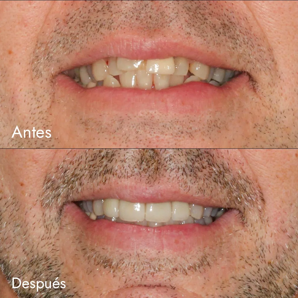 Ortodoncia invisible