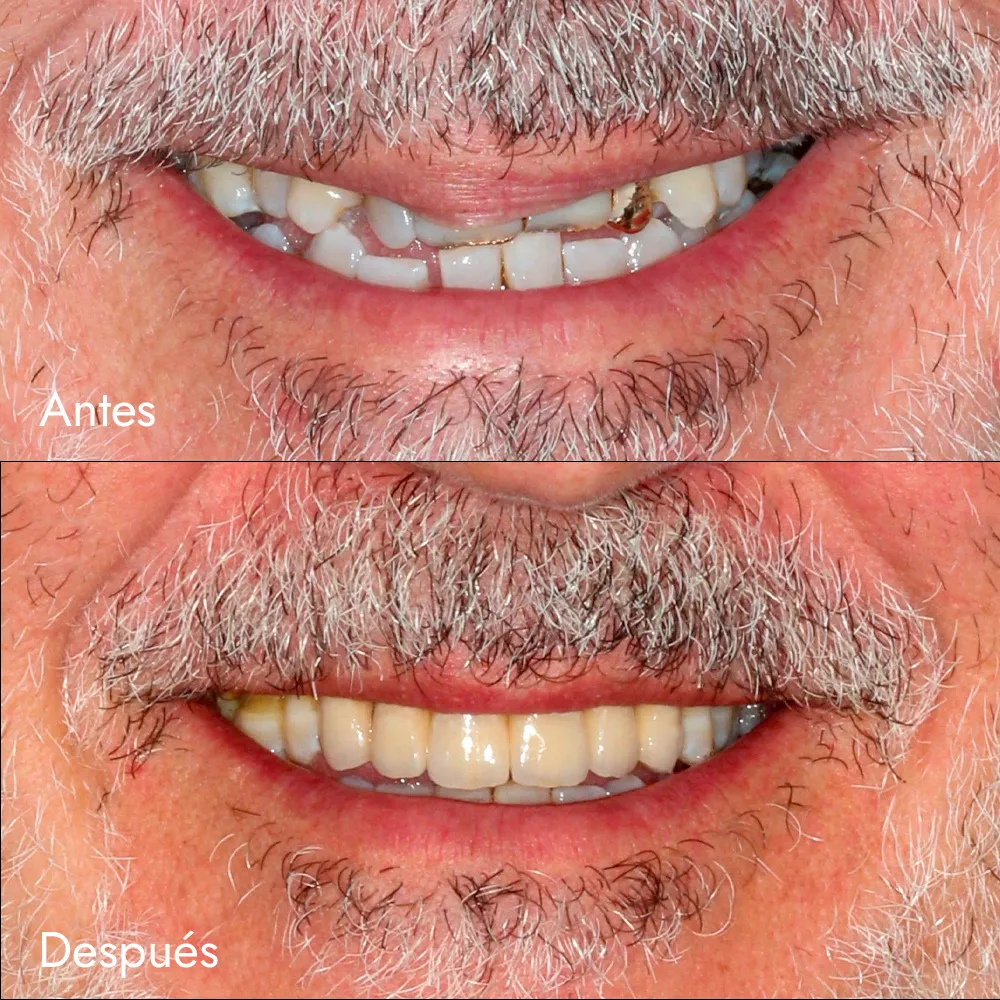 Prótesis fijas sobre dientes