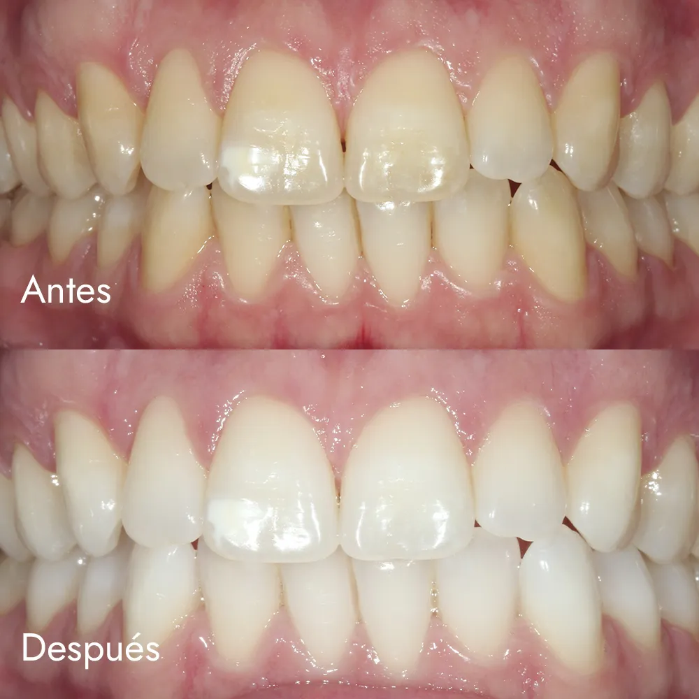 Blanqueamiento dental