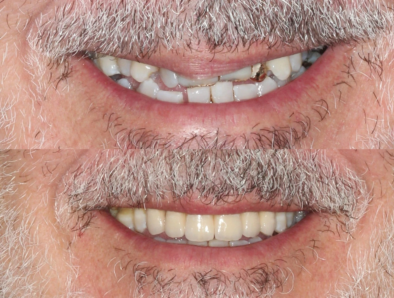 Diseño de Sonrisa (DSD)