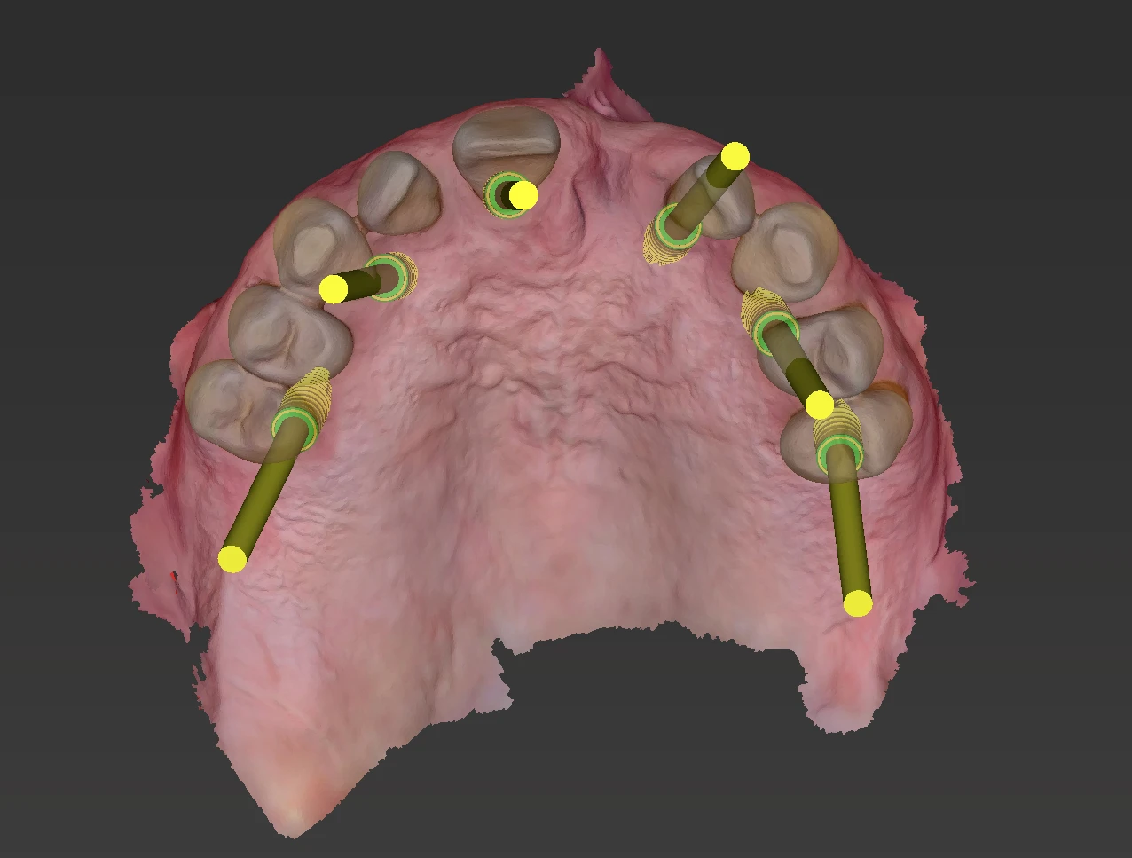 Implantes + dientes provisionales fijos en 1 día