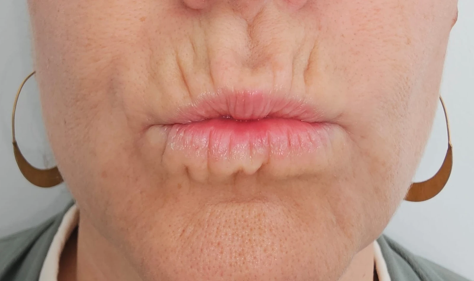 Código de Barras y Surcos Labiales