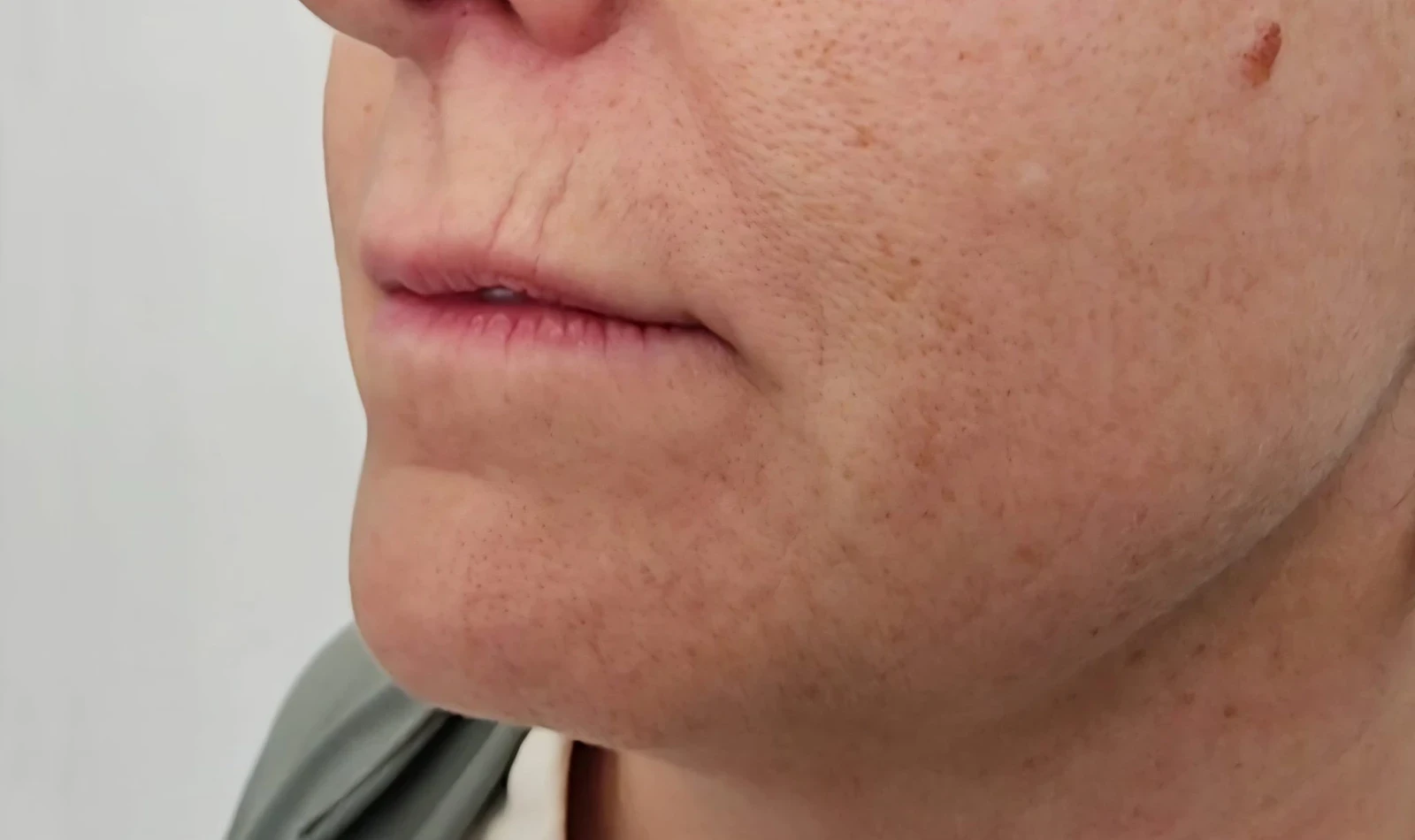 Código de Barras y Surcos Labiales