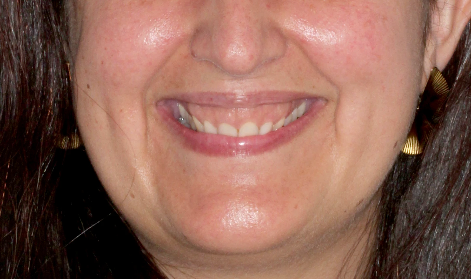 acido sonrisa gingival