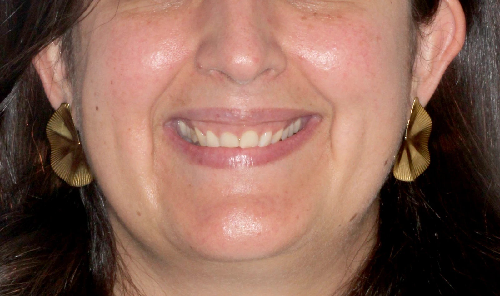 acido sonrisa gingival