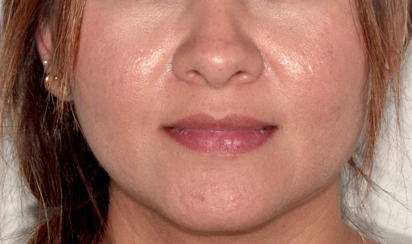 Volumen y Contorno Labial