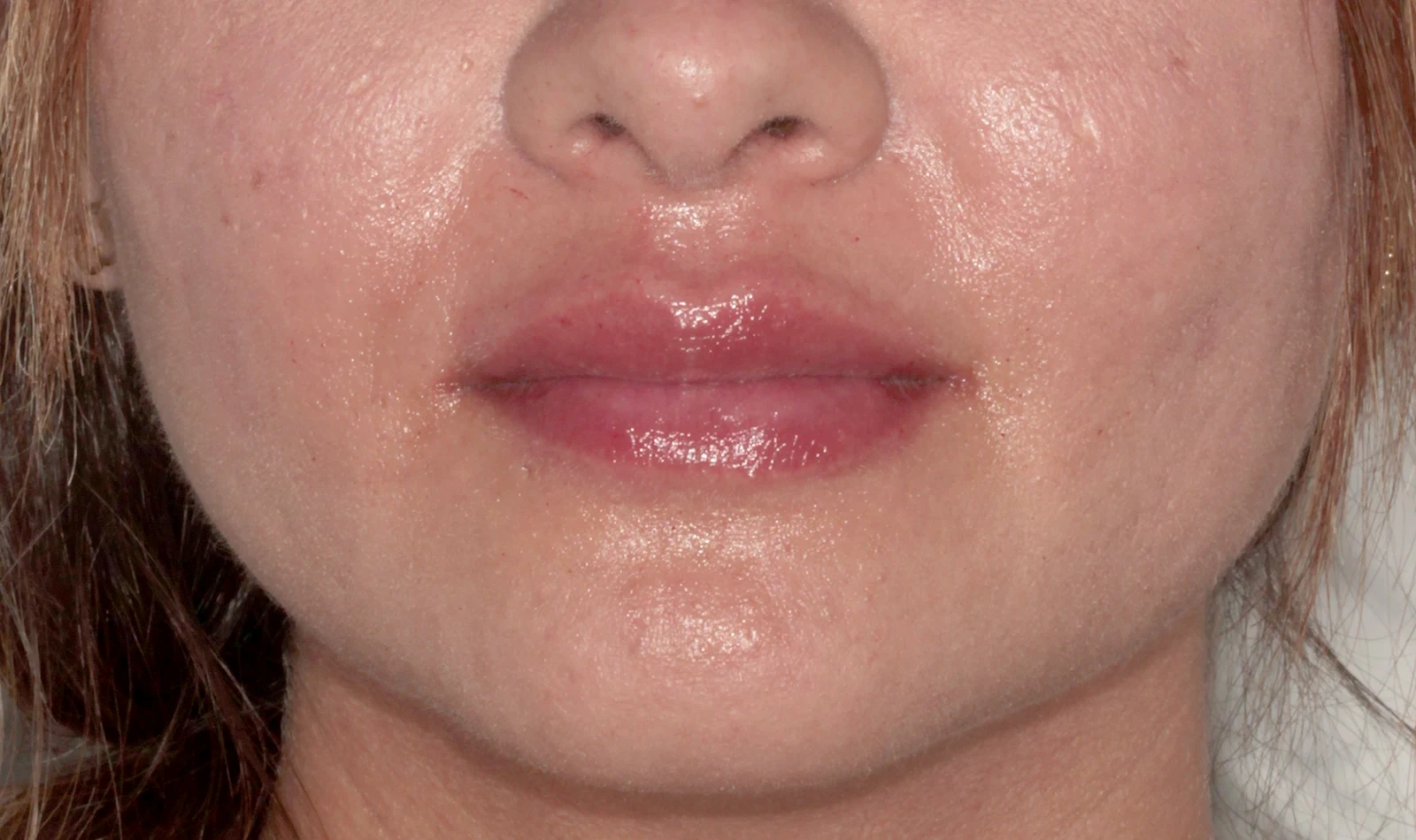 Volumen y Contorno Labial