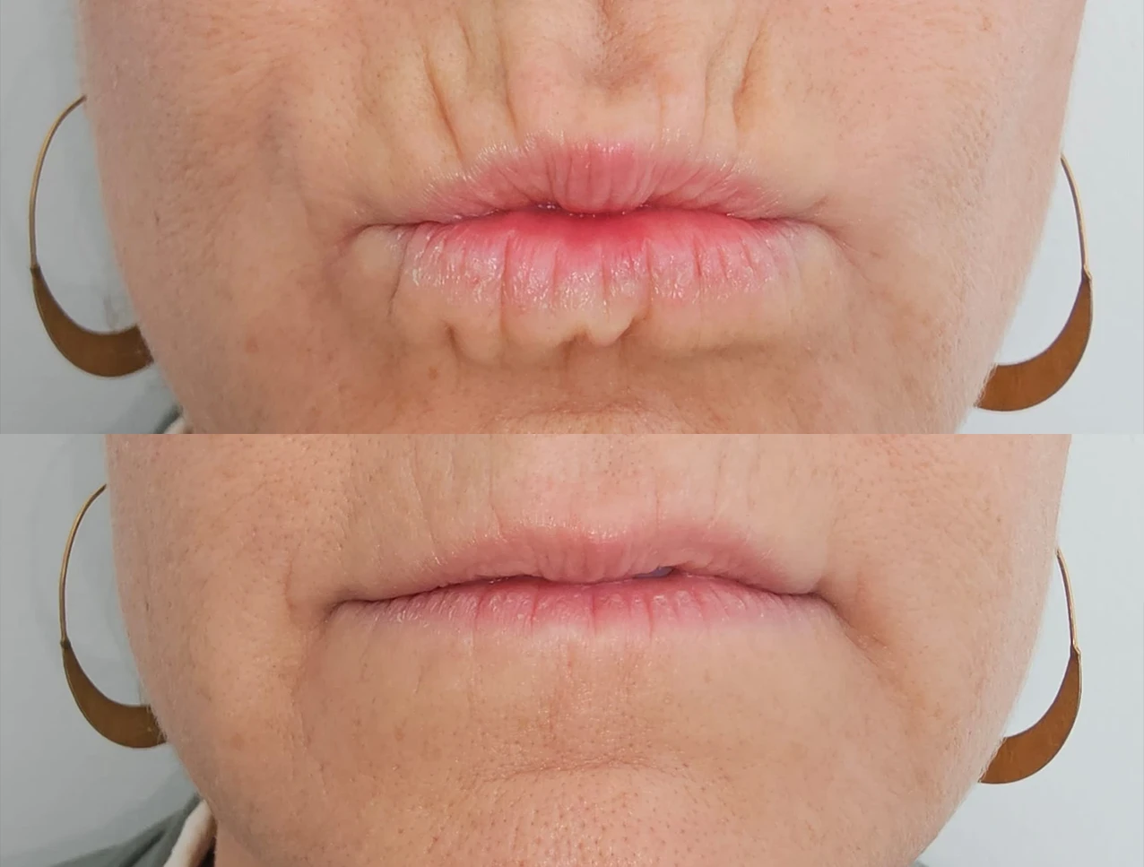 Ácido hialurónico e Inductores de Colágeno para la armonización orofacial