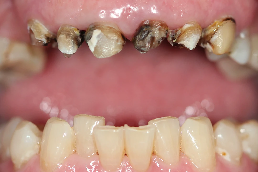 Carga inmediata alzamora dental