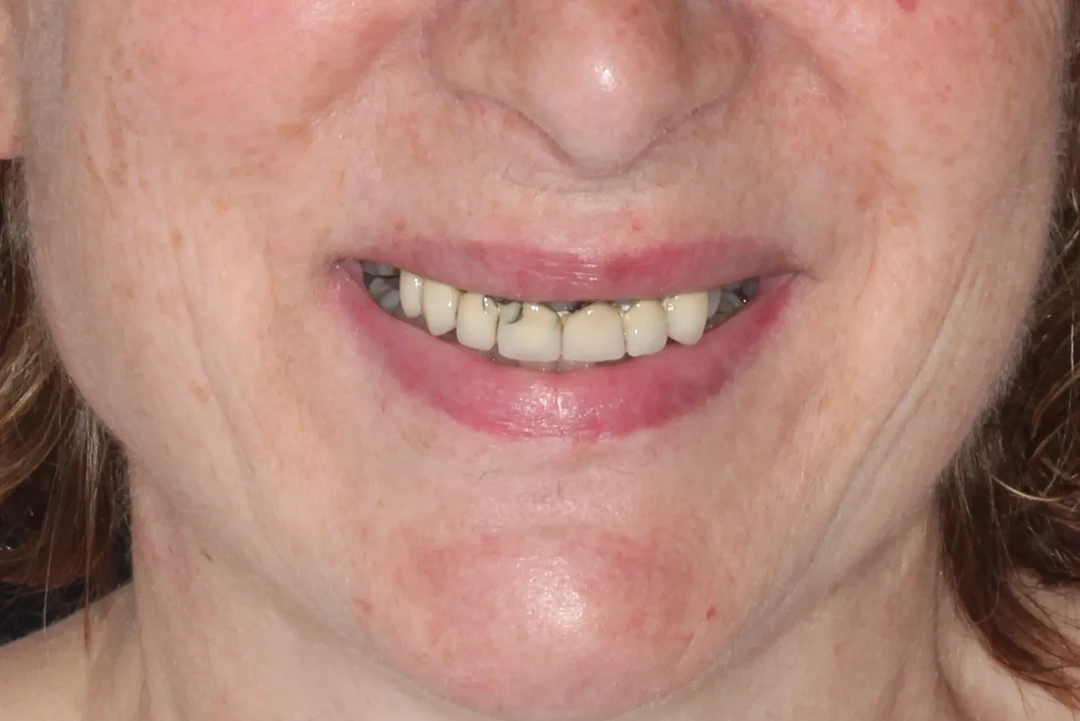 Carga inmediata alzamora dental