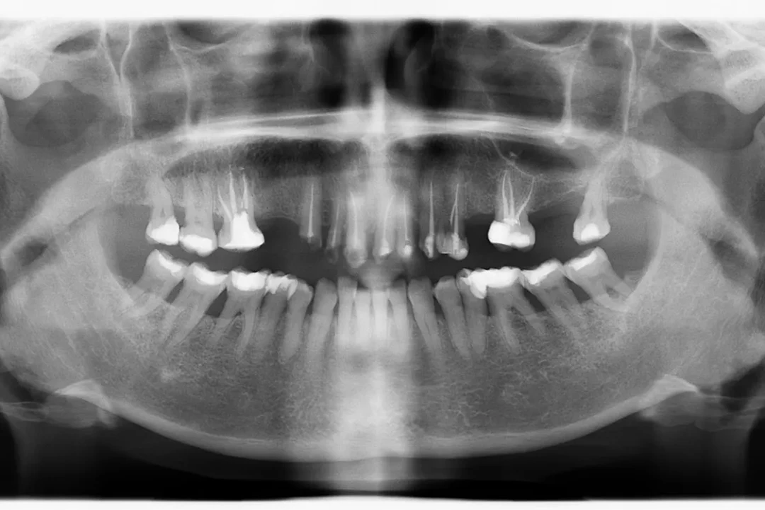 Carga inmediata alzamora dental