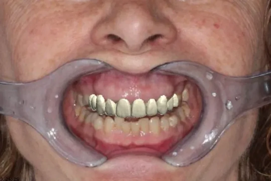 Carga inmediata alzamora dental