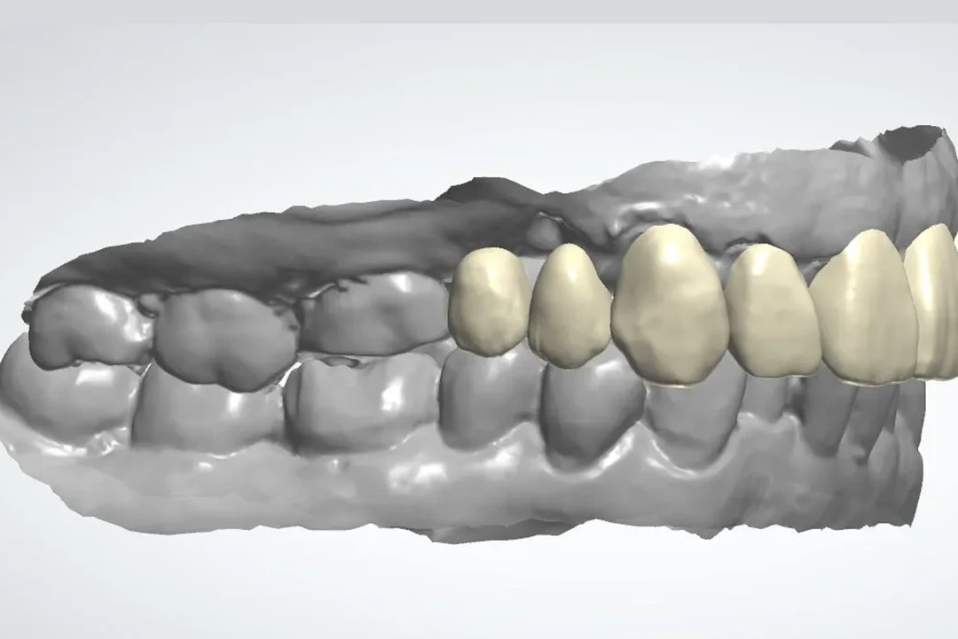 Carga inmediata alzamora dental