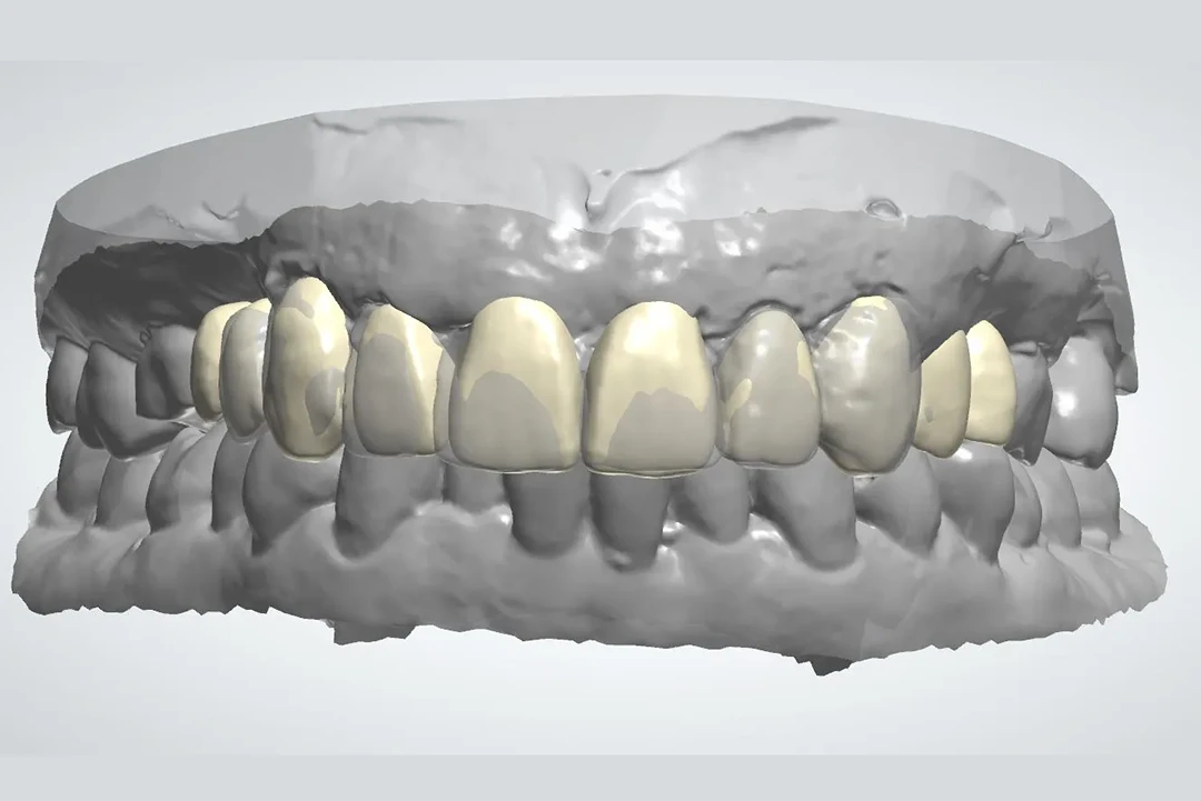 Carga inmediata alzamora dental