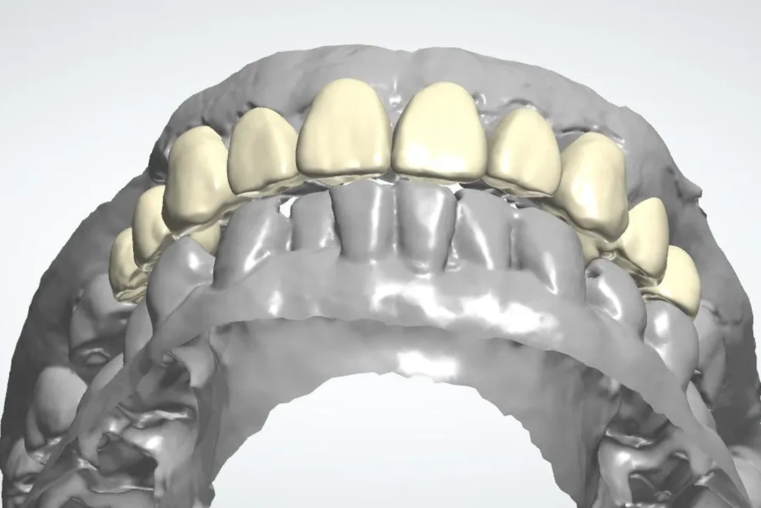 Carga inmediata alzamora dental