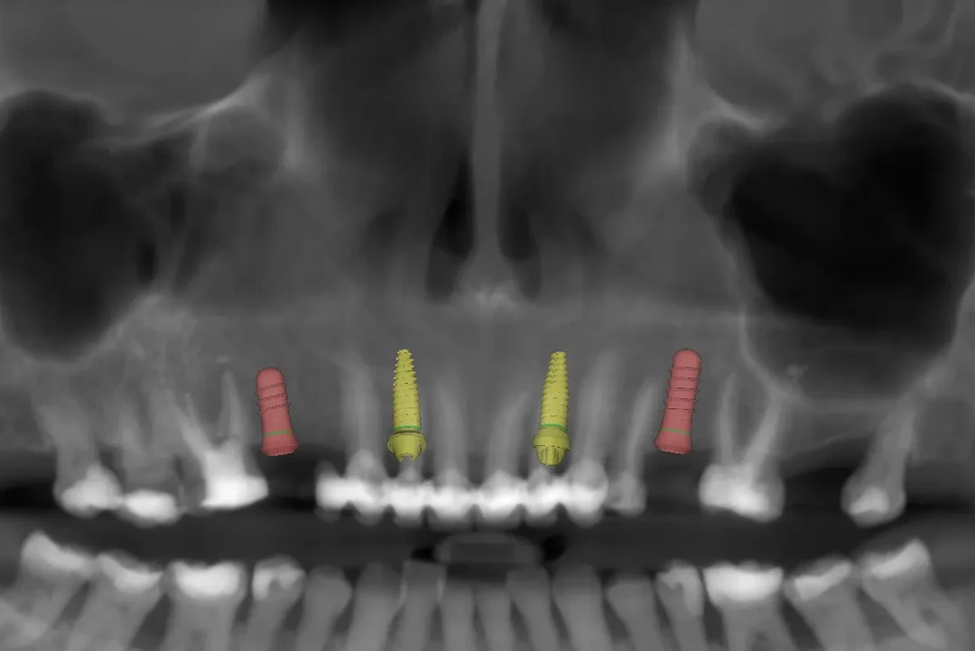 Carga inmediata alzamora dental