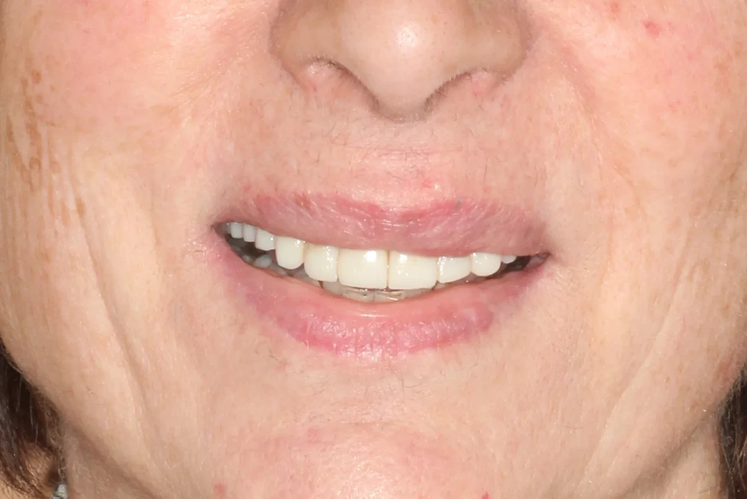 Carga inmediata alzamora dental