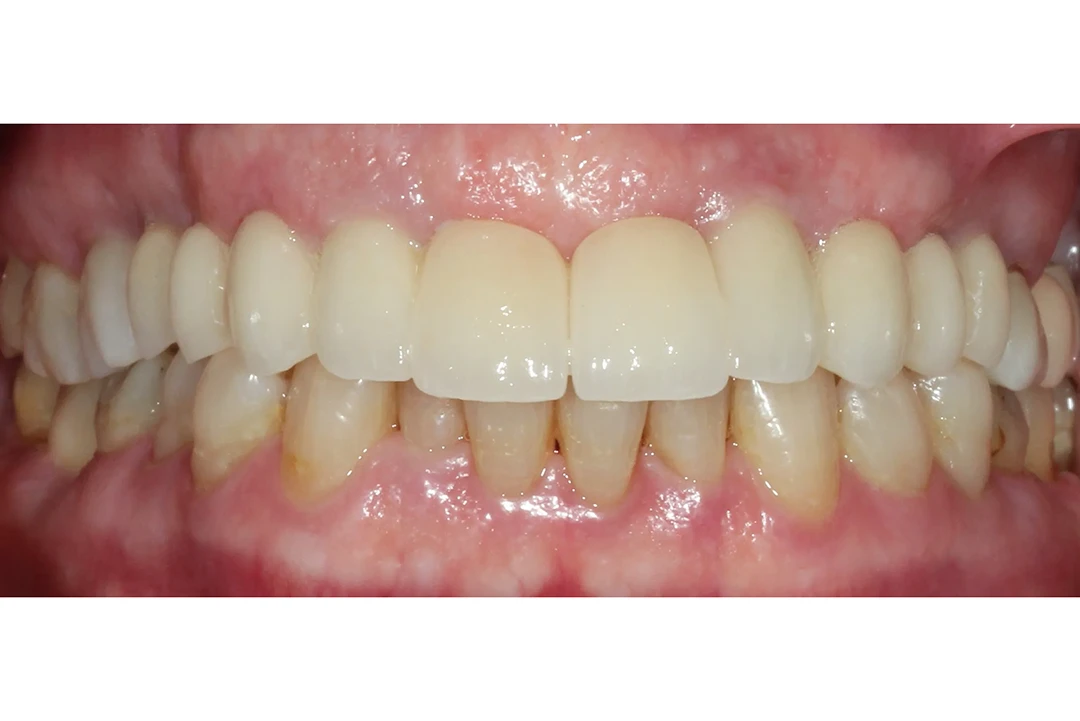 Carga inmediata alzamora dental