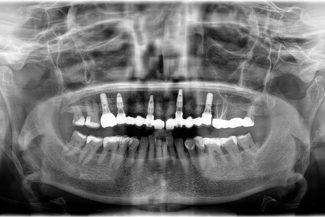 Carga inmediata alzamora dental