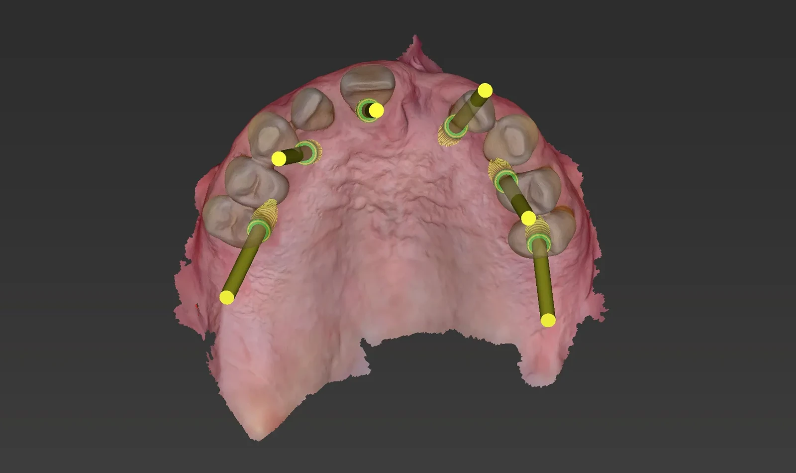 cirugia guiada alzamora