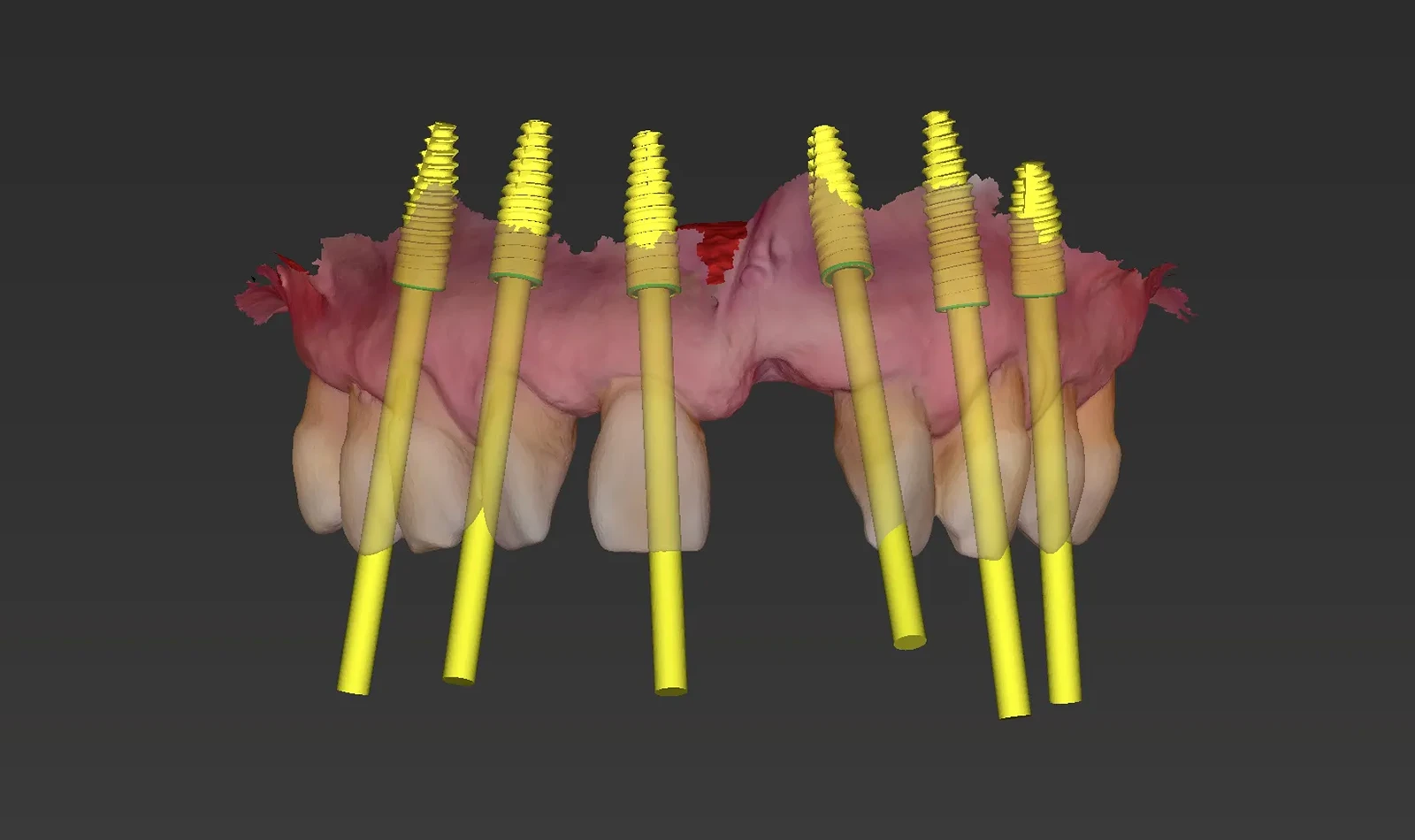 cirugia guiada alzamora
