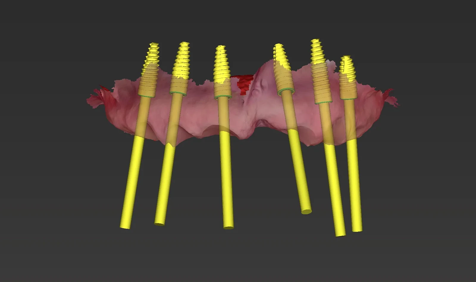 cirugia guiada alzamora
