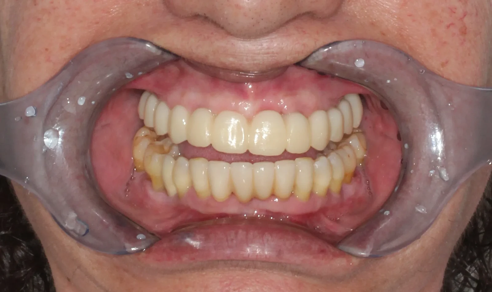 cirugia guiada alzamora