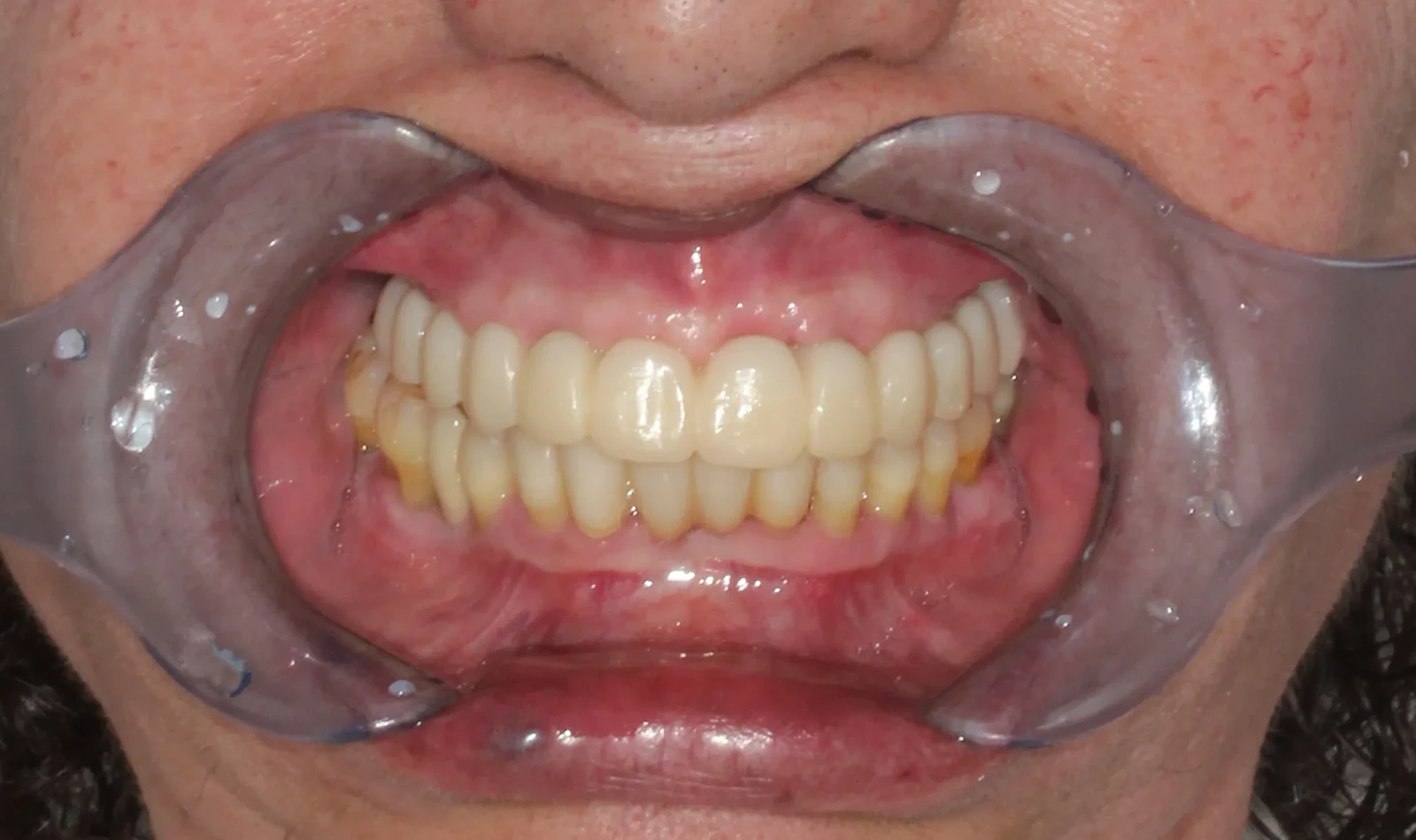 cirugia guiada alzamora