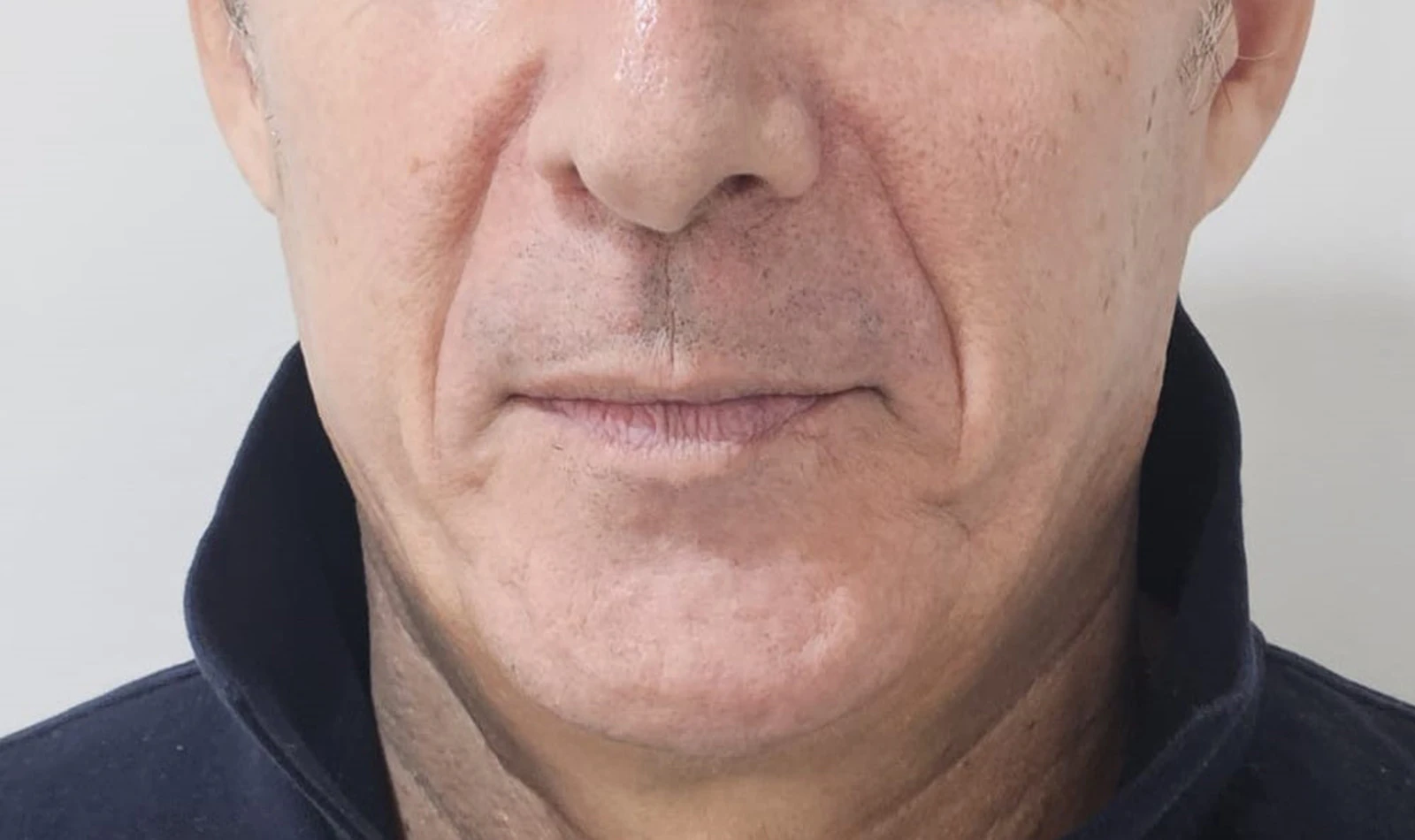 Inductores de Colágeno