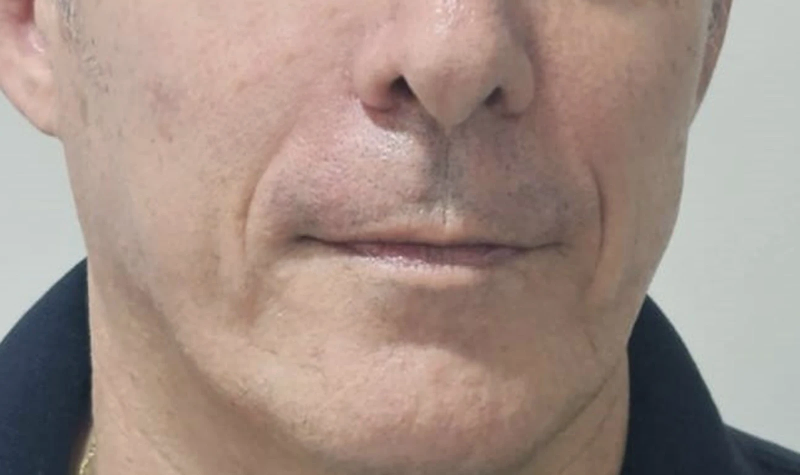 Inductores de Colágeno